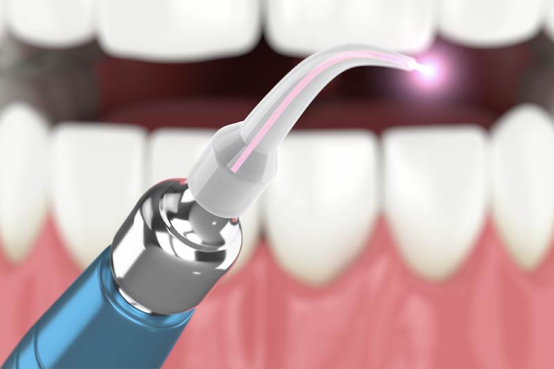 Tongue Tie Treatment at Little Teeth Pediatric Dentistry & Orthodontics